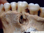L_V20d5081 A16.31 R827 lR ta close-up, abscess on maxilla.JPG L_V20d5081 A16.31 R827 lR ta close-up, abscess on maxilla
